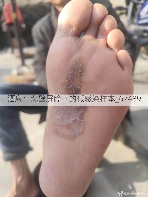 酒泉：戈壁屏障下的低感染样本_67489